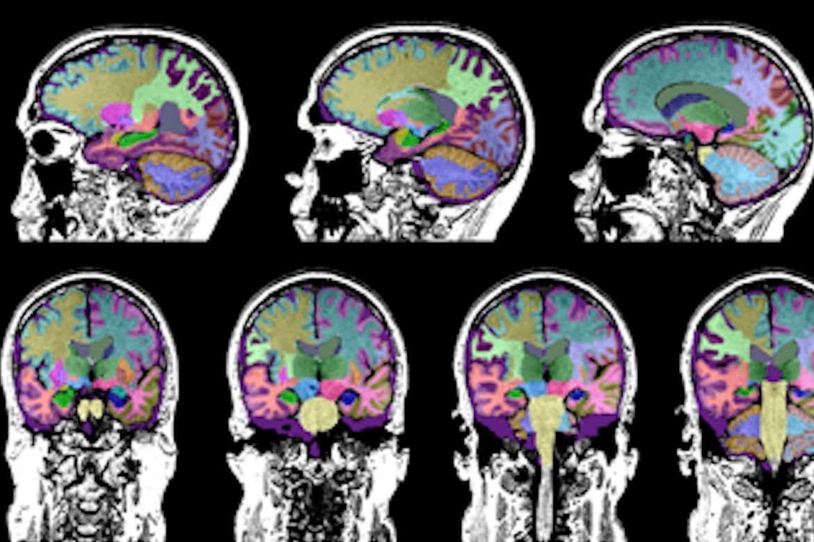 MRI brain scans